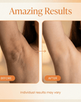 LumaFade™  Kojic + Turmeric Body Peel Spray – Visibly Brighten Dark Spots Fast