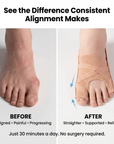 Alignova™ Foot Corrector – Restore Natural Toe Alignment at Home